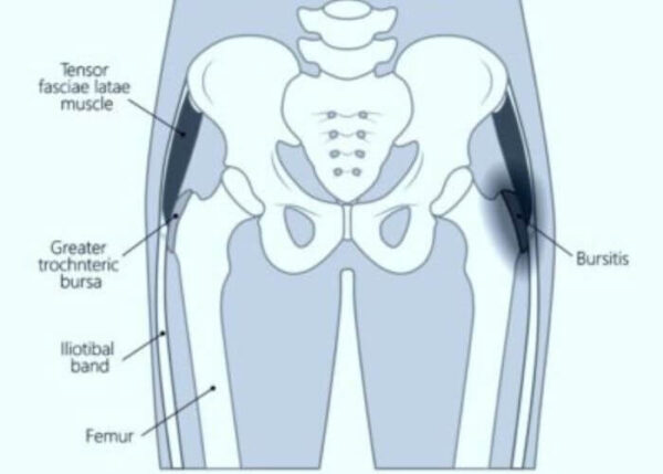 Trochanteric Bursectomy Orthopedic Hip Surgeon Manhattan New York Ny