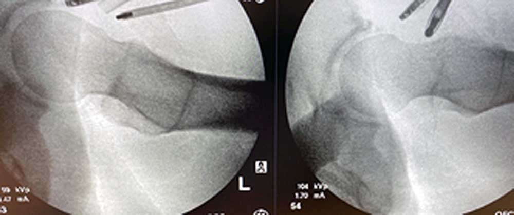 Cam Deformity (left) Femoroplasty (right)