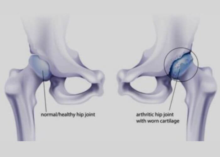 Normal and Arthritic Hip | Manhattan NY