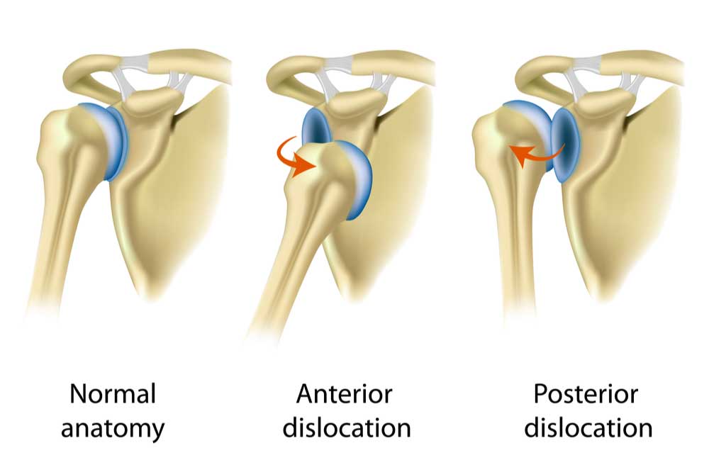 Dislocated Shoulder Doctor | Manhattan NY