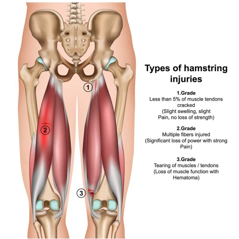 can-hamstring-cause-calf-pain