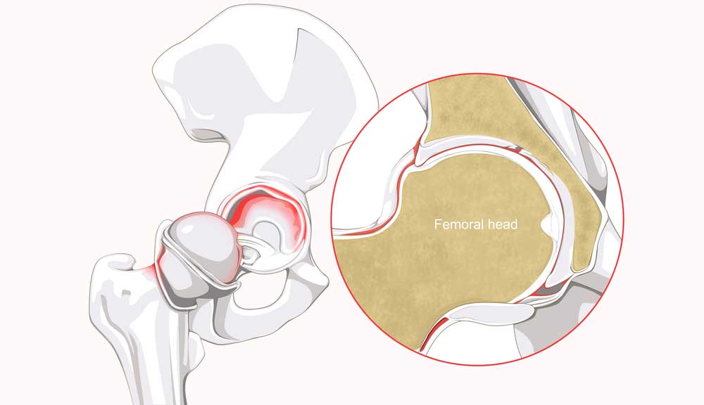 Hip Labrum Repair and Reconstruction Surgery | New York City, NY