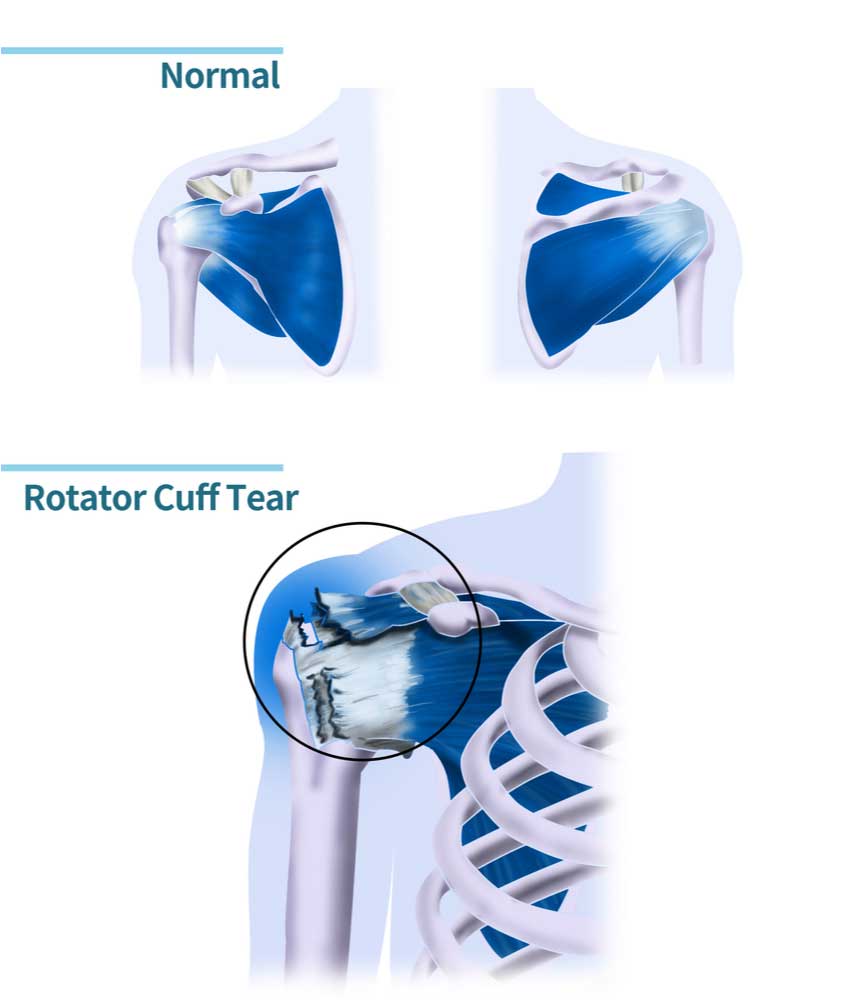 Rotator Cuff Tear Doctor | Manhattan NY