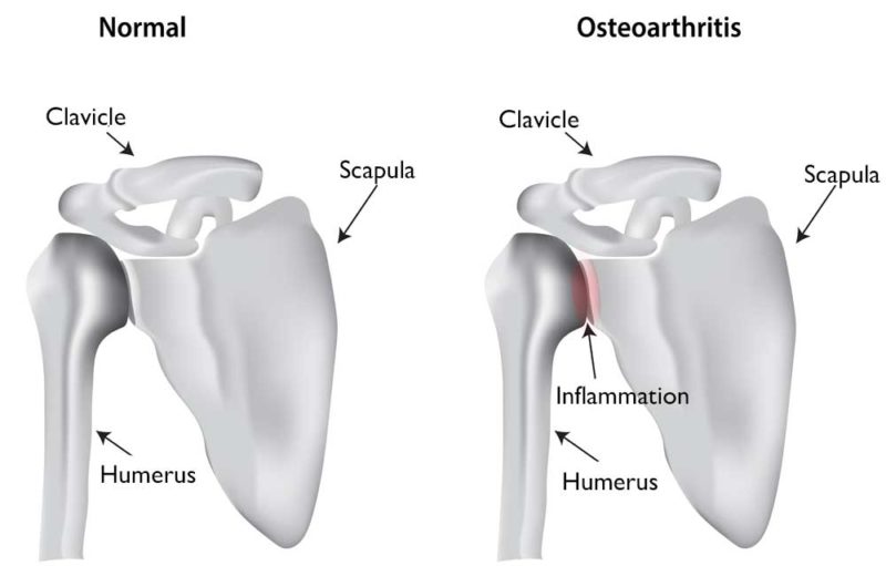 Shoulder Arthritis Orthopedic Shoulder Specialist Manhattan, New
