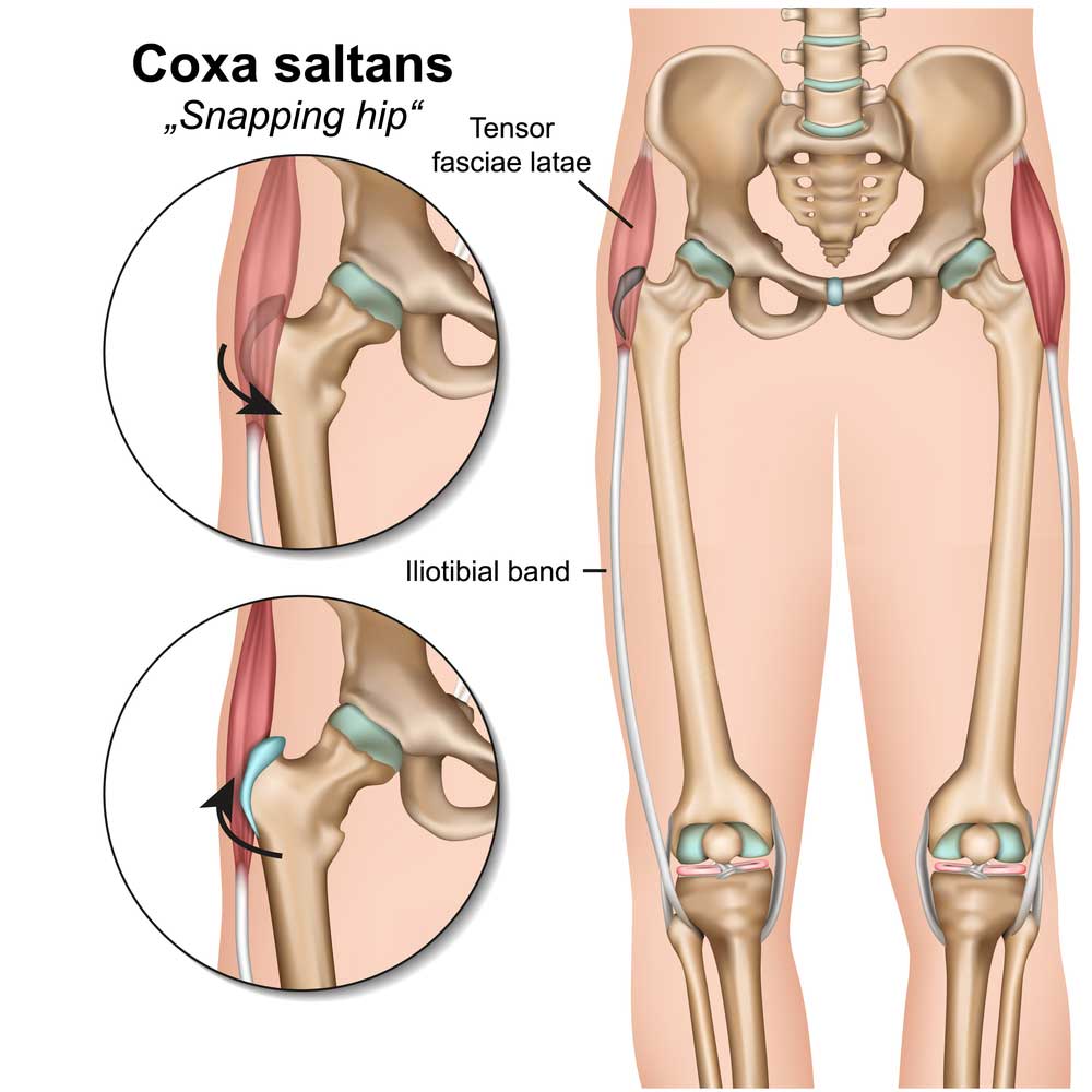 Snapping Hip Syndrome, Orthopedic Hip Specialist