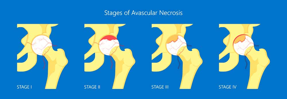 Stages of Avascular Necrosis Hip Doctor | New York City, NY