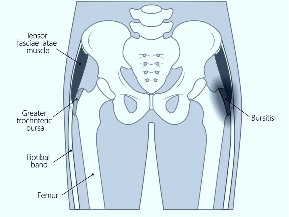 Bursitis Hip Pain Location Diagram