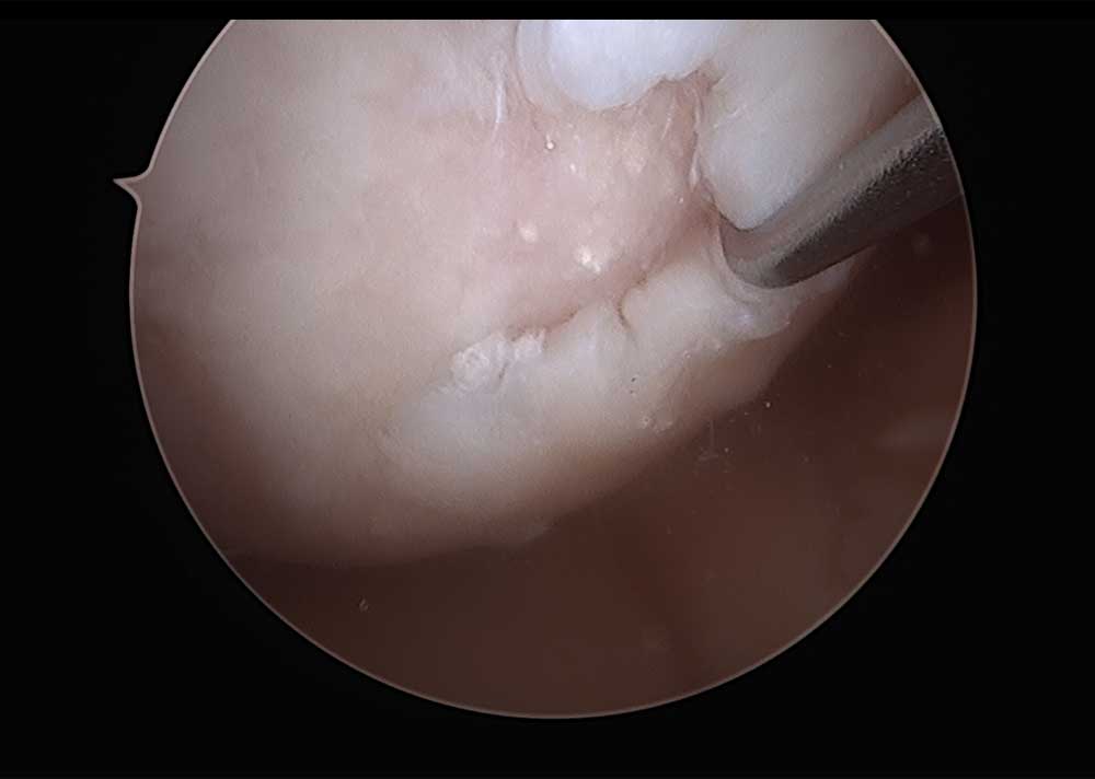 Cartilage Defect Identified During Arthroscopy
