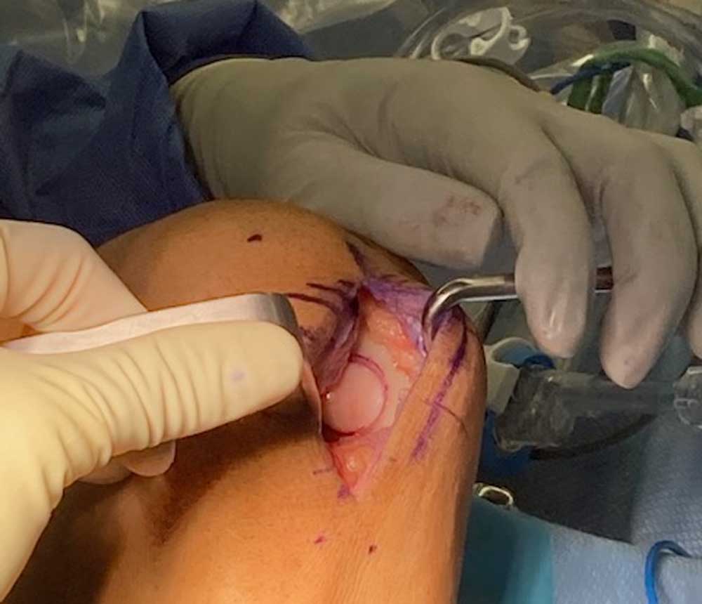 Osteochondral Allograft Plug After Insertion for Resurfacing