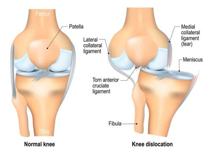 Knee Dislocation | Manhattan NY