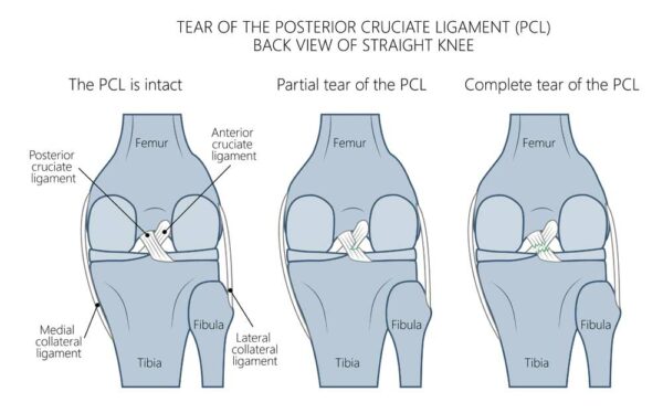 PCL Injury | Posterior Cruciate Ligament | Orthopedic Knee Specialist ...