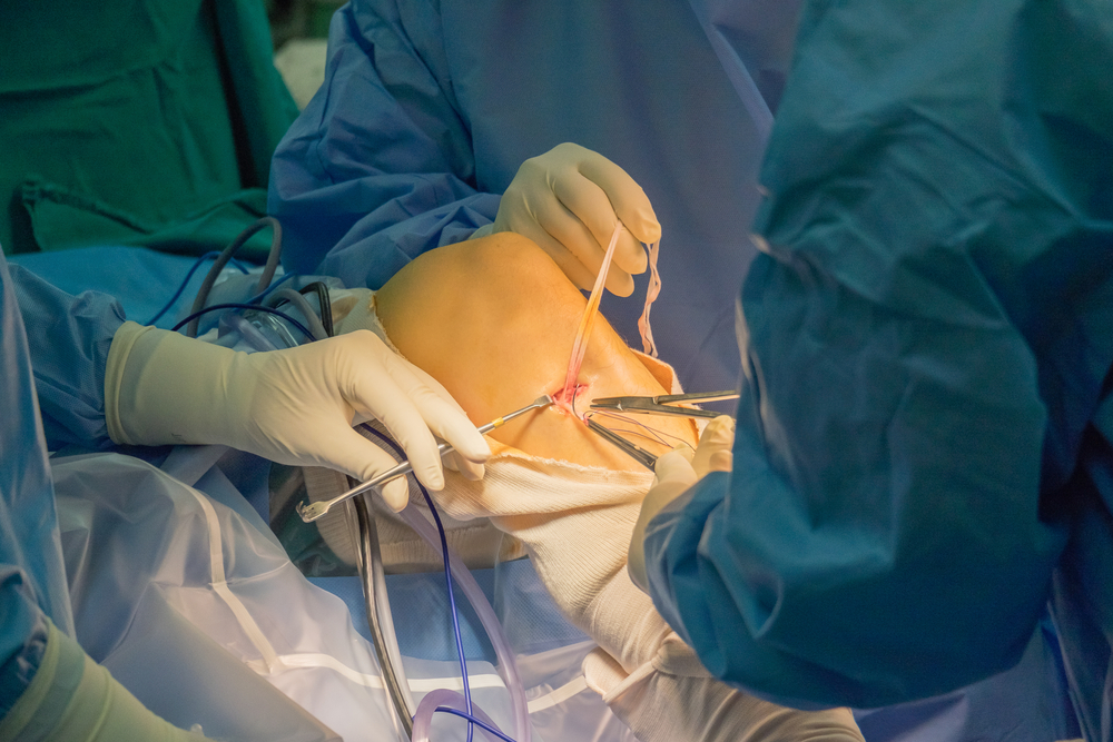 ACL Reconstruction | Anterior Cruciate Ligament | Orthopedic Knee