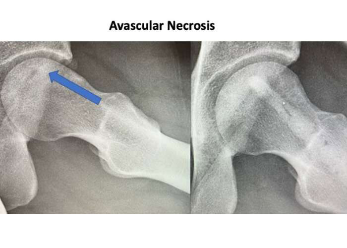 Avascular Necrosis of the Femoral Head in the Hip | Manhattan, NY
