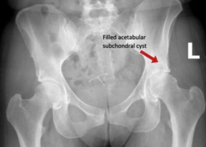 Acetabular Subchondral Cyst | Manhattan NY