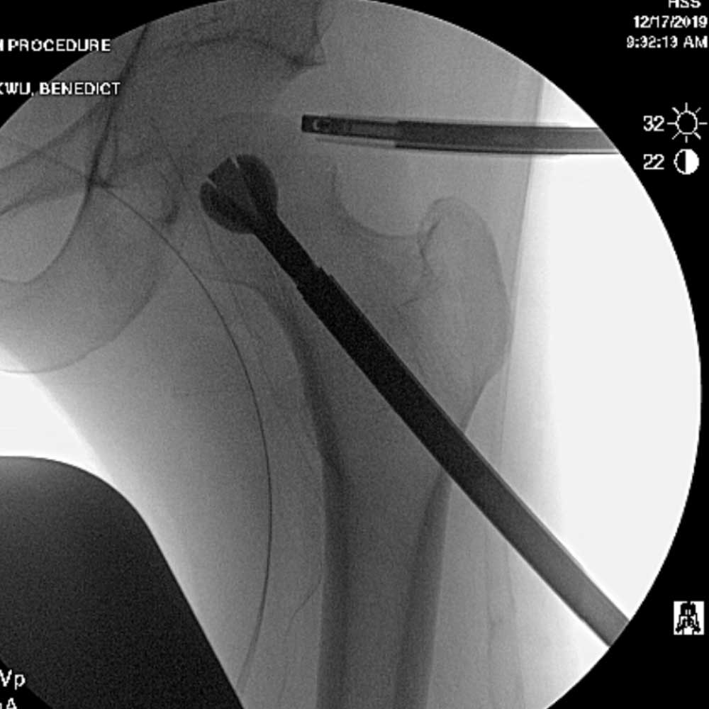 Intraoperative hip core decompression performed safely under direct visualization with hip arthroscopy