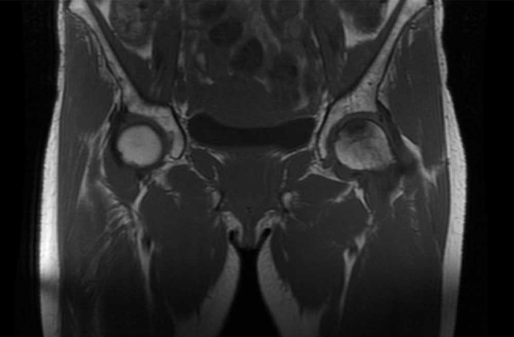 Pre-Operative MRI with Left Hip AVN and Pre-Collapse