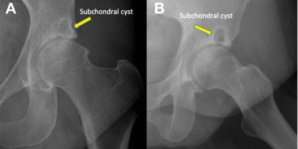 Subchondral Cysts in Hip | Manhattan NY