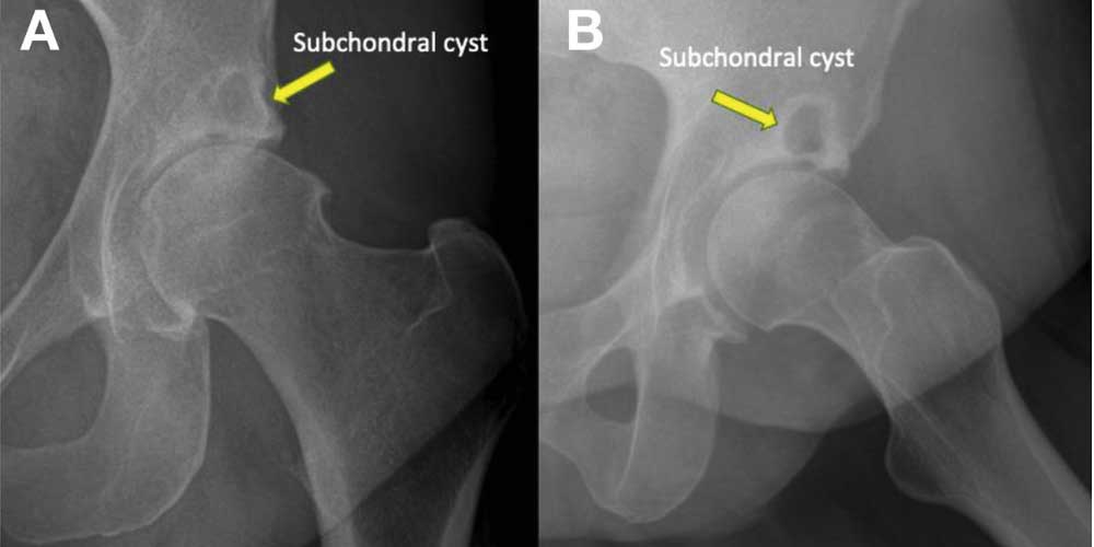 Subchondral Cyst