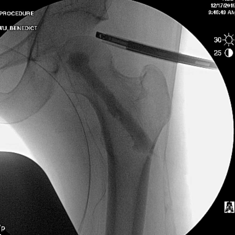 Intraoperative hip core decompression performed safely under direct visualization with hip arthroscopy - injection of bone substitute with stem cells