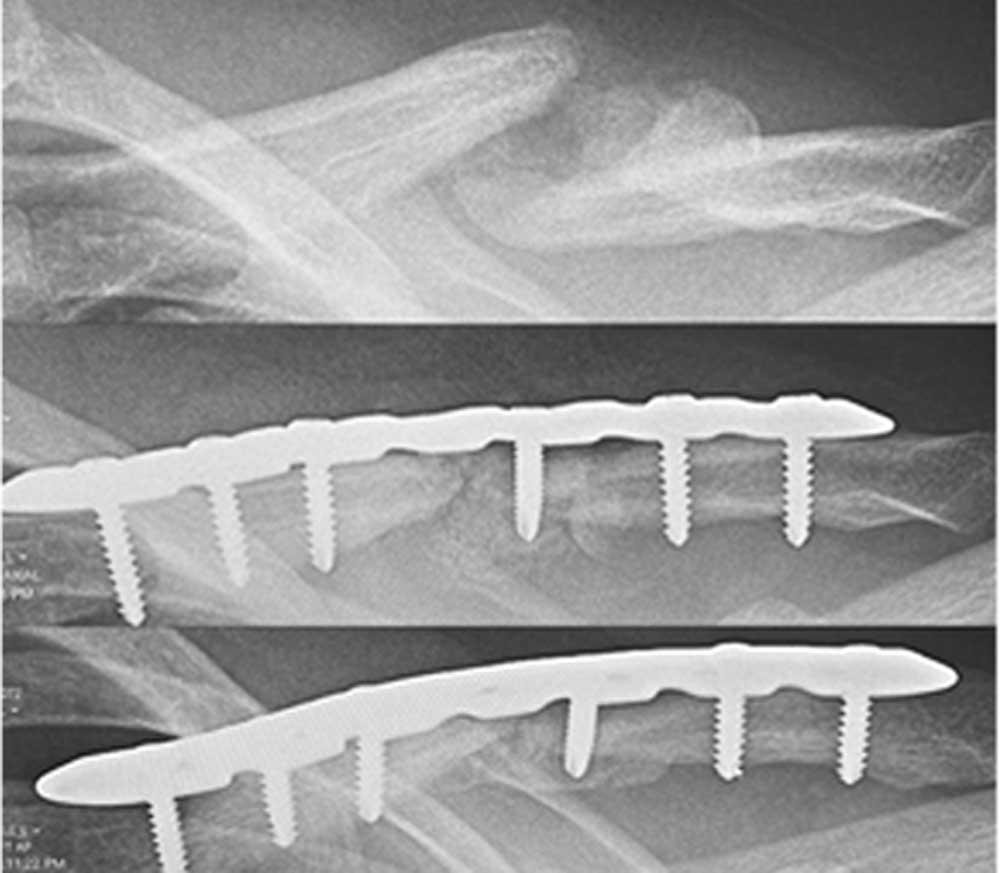 Clavicle Fracture Fixation | Manhattan NY