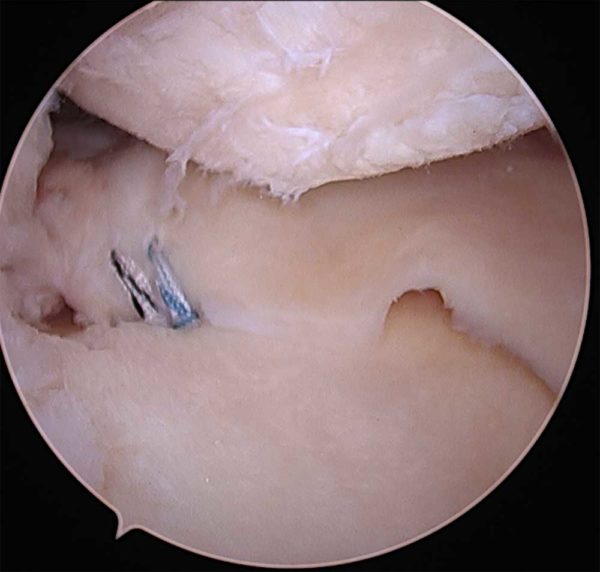 Meniscus Root Tear Repair Orthopedic Knee Surgeon