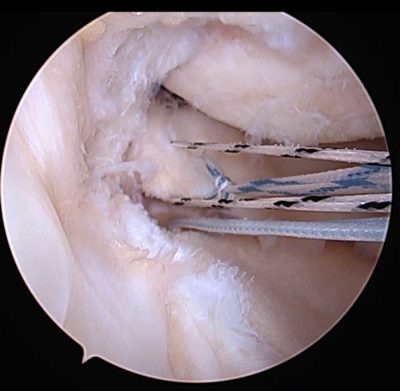 meniscus orthopedic