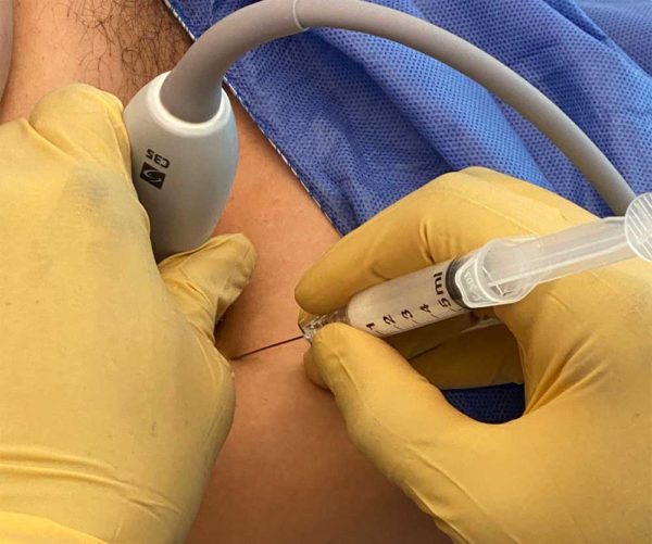 Ultrasound Guided Hip Treatment | Hip Injury Non-Surgical Treatment ...