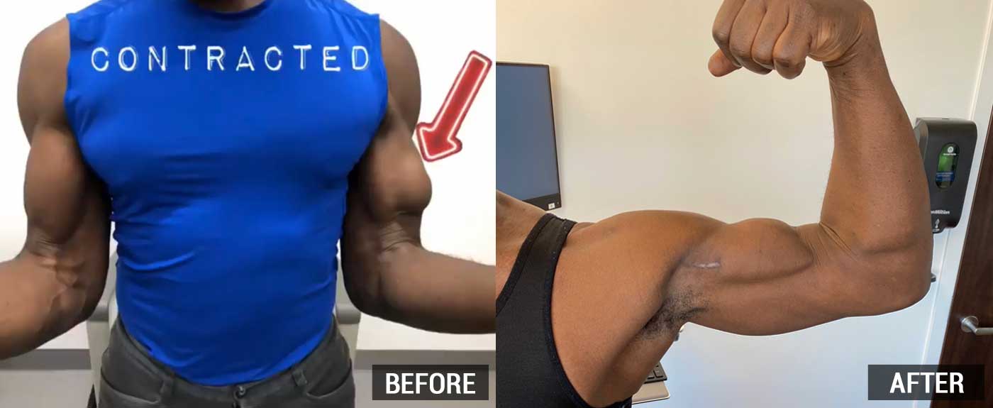 Biceps Tendon Rupture Before and After Surgery Images