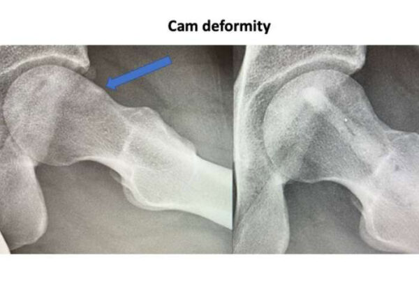 Cam Deformity in the Hip | Manhattan, NY