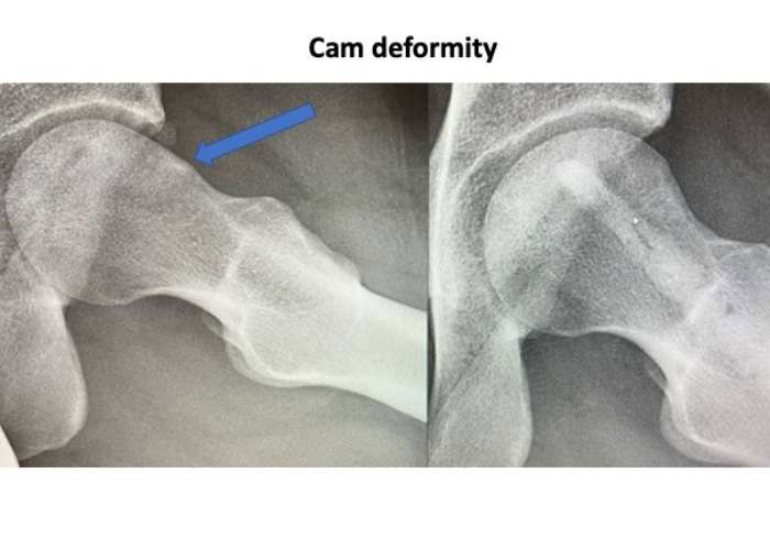 Cam Deformity in the Hip | Manhattan, NY