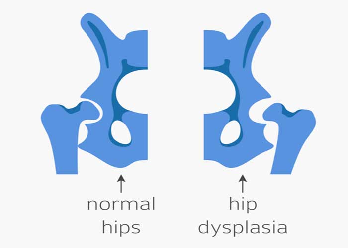 Hip Dysplasia | Manhattan NY