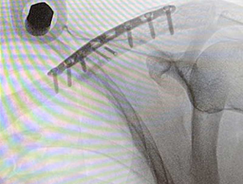 Clavicle Fracture Fixation