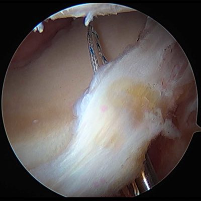 Hip Labrum Repair, First Suture