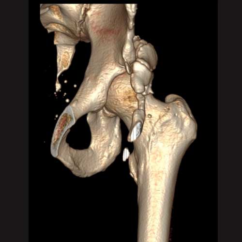 Excision of Heterotopic Ossification | Hip Impingement | Orthopedic Hip